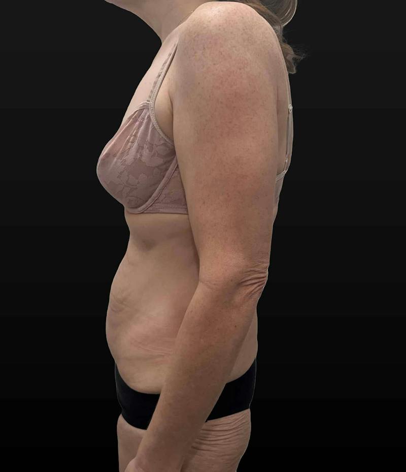 Abdominoplasty (Tummy Tuck) Before & After Gallery - Patient 631139 - Image 5