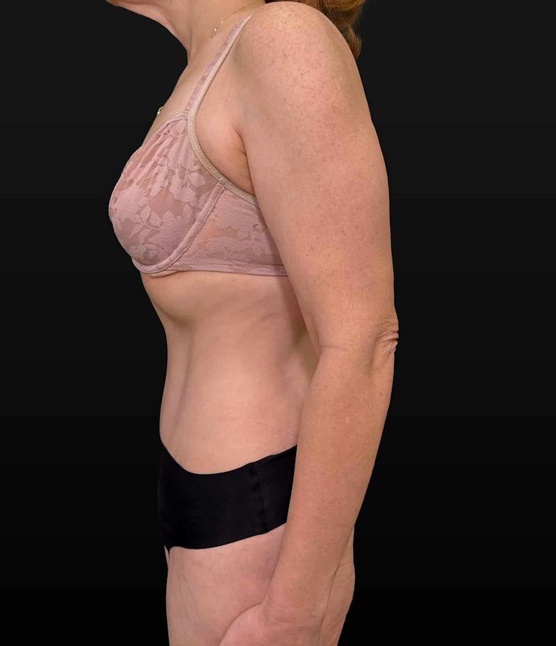 Abdominoplasty (Tummy Tuck) Before & After Gallery - Patient 631139 - Image 6