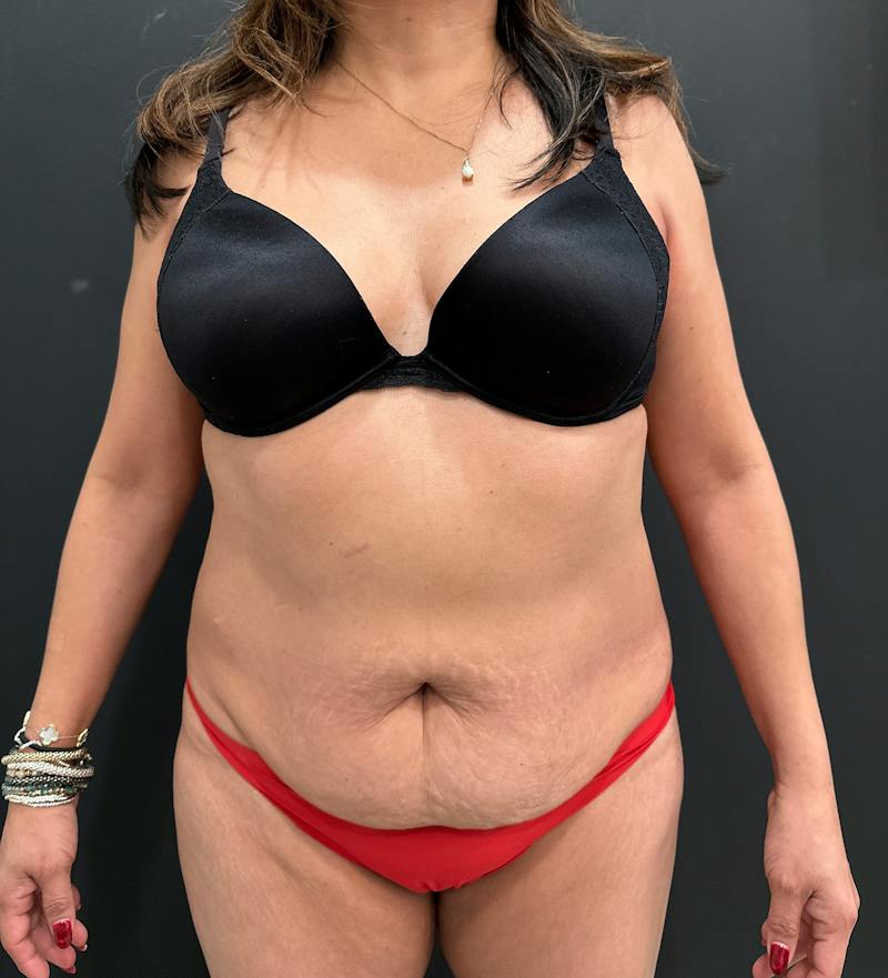SAFElipo Circ Trunk Before & After Gallery - Patient 346221 - Image 1