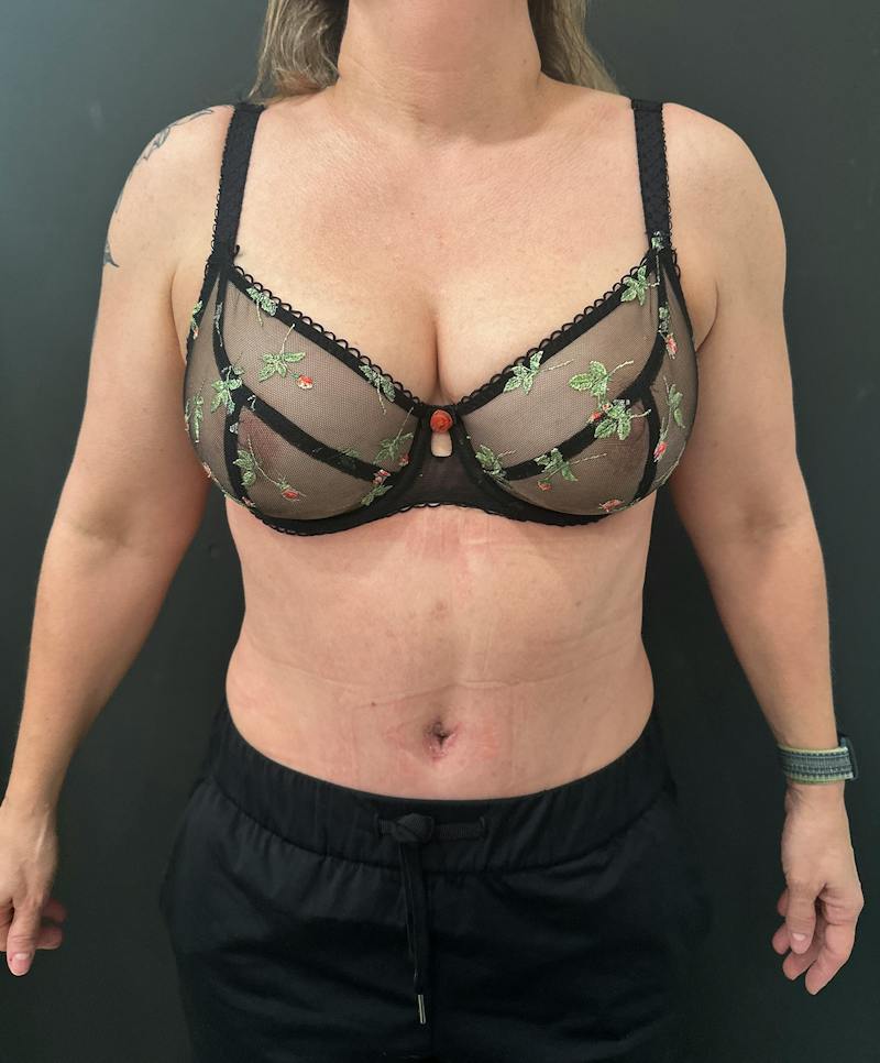 Abdominoplasty (Tummy Tuck) Before & After Gallery - Patient 238094 - Image 2