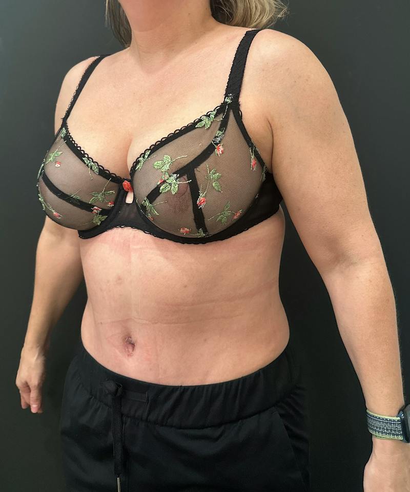 Abdominoplasty (Tummy Tuck) Before & After Gallery - Patient 238094 - Image 4