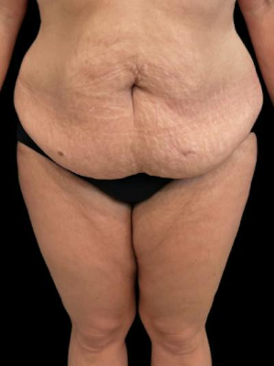 SAFElipo Circ Trunk Before & After Gallery - Patient 148361 - Image 1