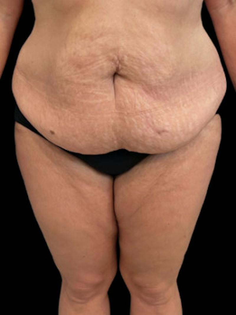 Abdominoplasty (Tummy Tuck) Before & After Gallery - Patient 361041 - Image 1