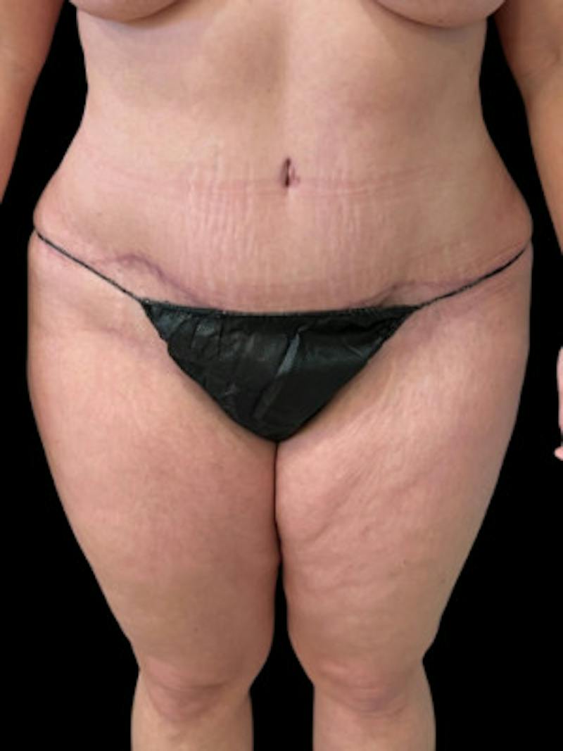 Abdominoplasty (Tummy Tuck) Before & After Gallery - Patient 361041 - Image 2