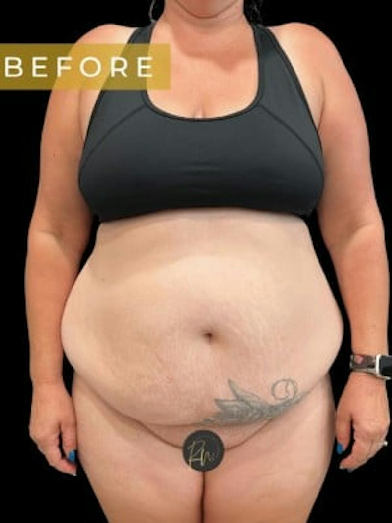 Abdominoplasty (Tummy Tuck) Before & After Gallery - Patient 923976 - Image 1