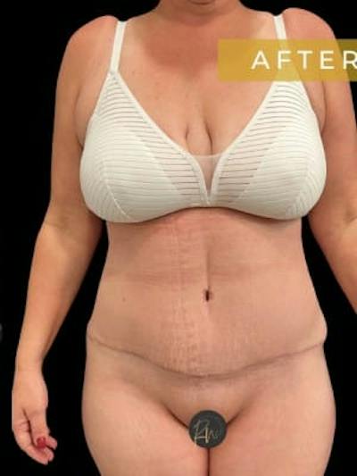 Abdominoplasty (Tummy Tuck) Before & After Gallery - Patient 923976 - Image 2