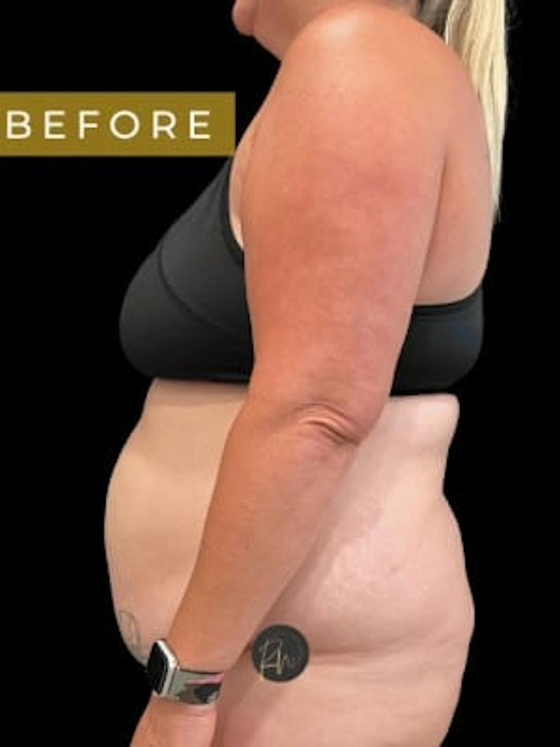 Abdominoplasty (Tummy Tuck) Before & After Gallery - Patient 923976 - Image 3