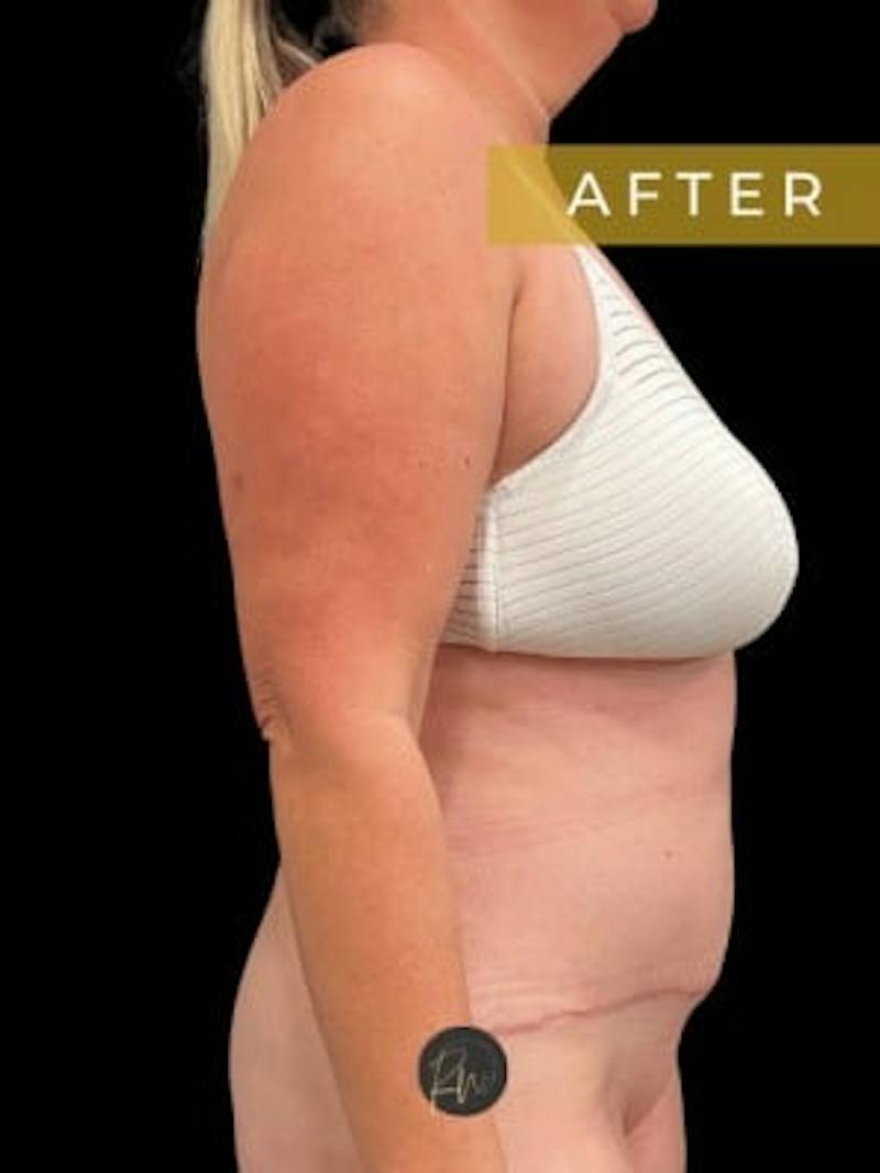 Abdominoplasty (Tummy Tuck) Before & After Gallery - Patient 923976 - Image 4