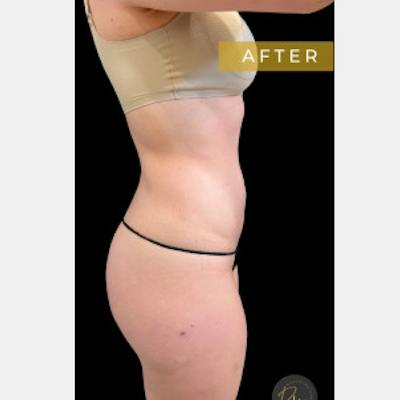 SAFElipo Circ Trunk Before & After Gallery - Patient 197145 - Image 2