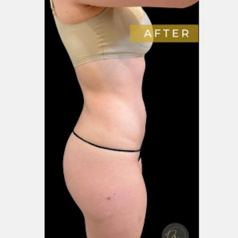 SAFElipo Circ Trunk Before & After Gallery - Patient 197145 - Image 2