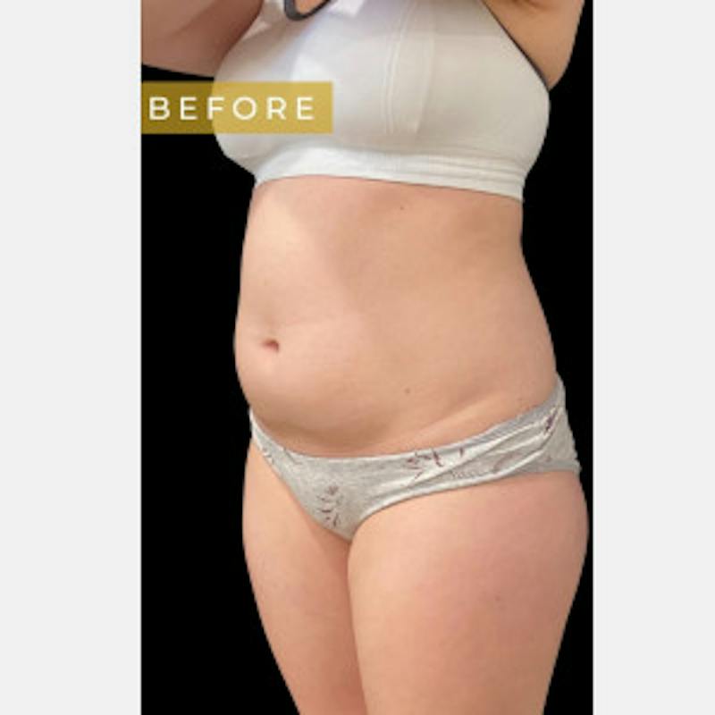 SAFElipo Circ Trunk Before & After Gallery - Patient 197145 - Image 3