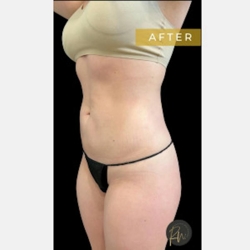 SAFElipo Circ Trunk Before & After Gallery - Patient 197145 - Image 4