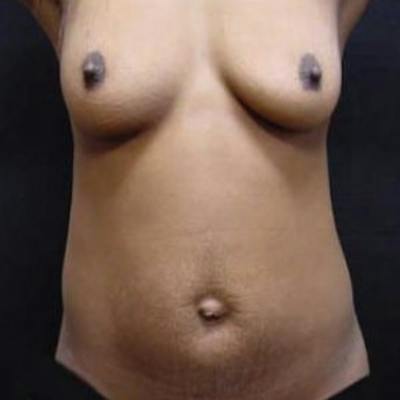 Mommy Makeover Before & After Gallery - Patient 238565 - Image 1