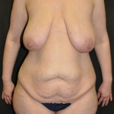 Mommy Makeover Before & After Gallery - Patient 328772 - Image 1