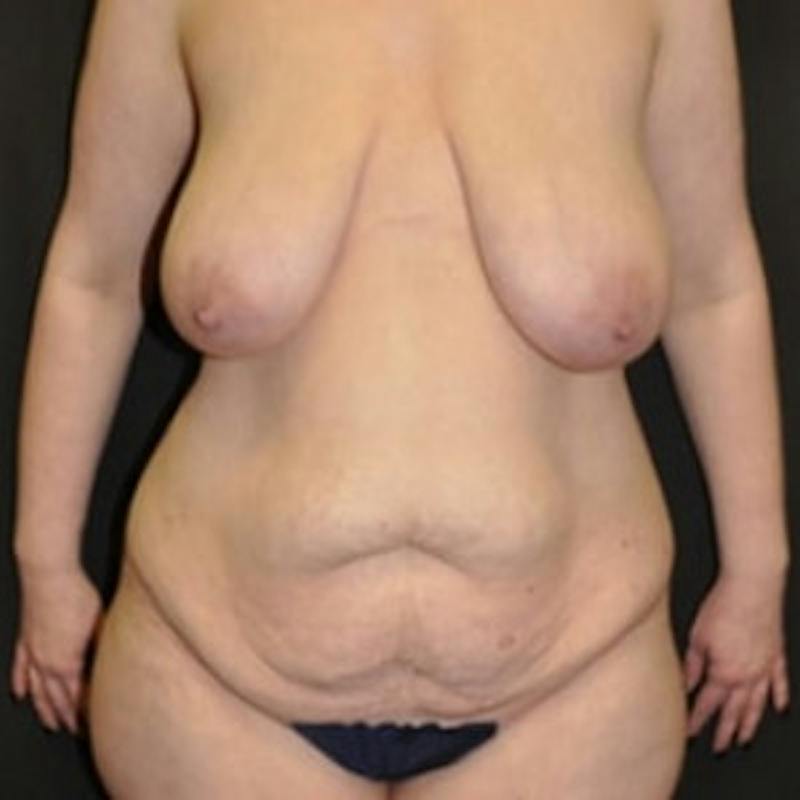 Mommy Makeover Before & After Gallery - Patient 328772 - Image 1