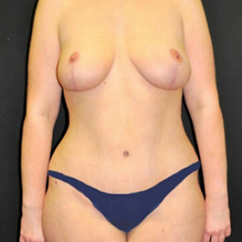 Mommy Makeover Before & After Gallery - Patient 328772 - Image 2