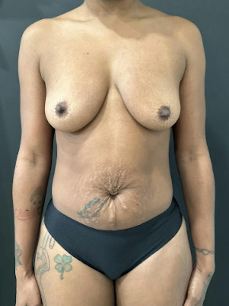 Abdominoplasty (Tummy Tuck) Before & After Gallery - Patient 302388 - Image 1