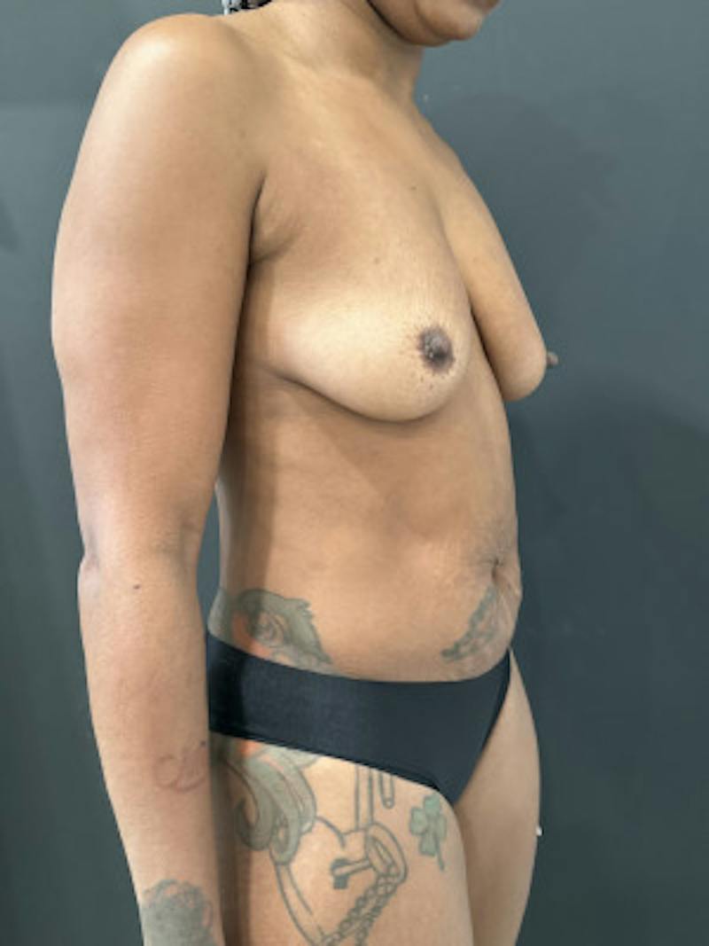 Abdominoplasty (Tummy Tuck) Before & After Gallery - Patient 302388 - Image 3
