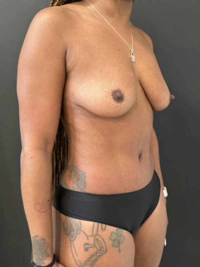 Abdominoplasty (Tummy Tuck) Before & After Gallery - Patient 302388 - Image 4