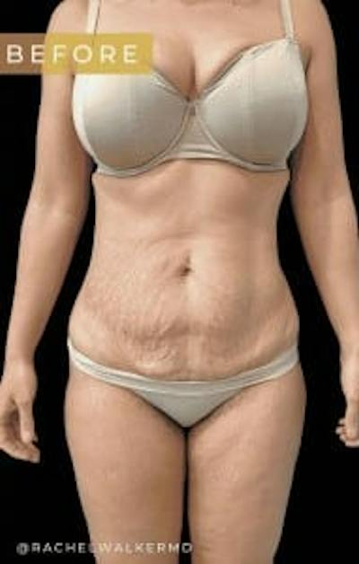 Abdominoplasty (Tummy Tuck) Before & After Gallery - Patient 344377 - Image 1