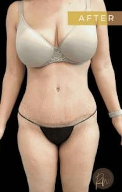 Abdominoplasty (Tummy Tuck) Before & After Gallery - Patient 344377 - Image 2