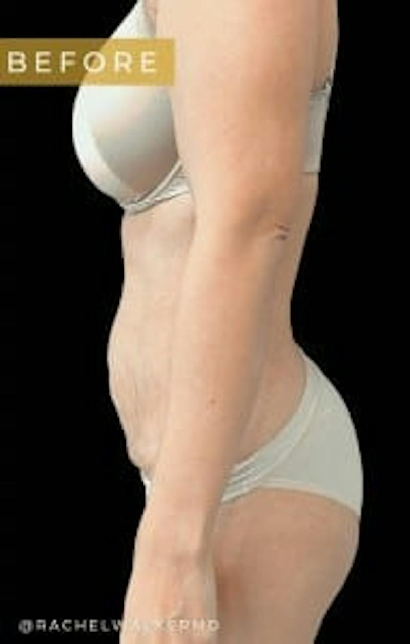 Abdominoplasty (Tummy Tuck) Before & After Gallery - Patient 344377 - Image 3