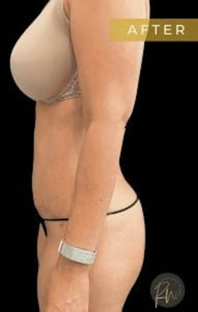 Abdominoplasty (Tummy Tuck) Before & After Gallery - Patient 344377 - Image 4