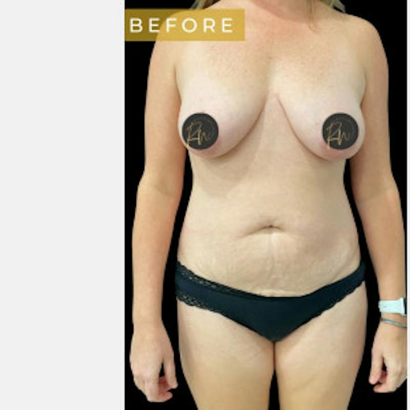 Abdominoplasty (Tummy Tuck) Before & After Gallery - Patient 344329 - Image 3