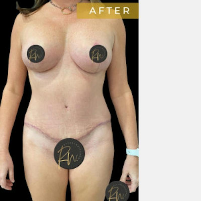 Abdominoplasty (Tummy Tuck) Before & After Gallery - Patient 344329 - Image 4