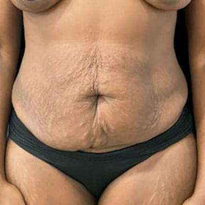 Abdominoplasty (Tummy Tuck) Before & After Gallery - Patient 344409 - Image 1