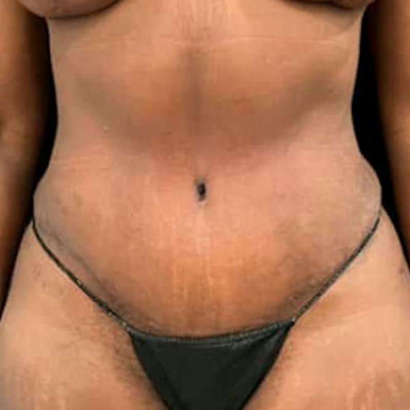 Abdominoplasty (Tummy Tuck) Before & After Gallery - Patient 344409 - Image 2