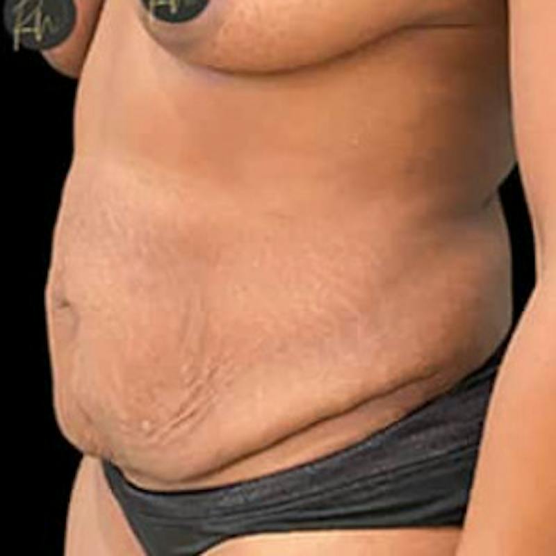 Abdominoplasty (Tummy Tuck) Before & After Gallery - Patient 344409 - Image 3