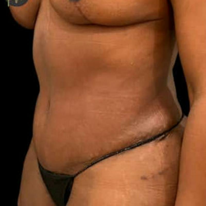 Abdominoplasty (Tummy Tuck) Before & After Gallery - Patient 344409 - Image 4