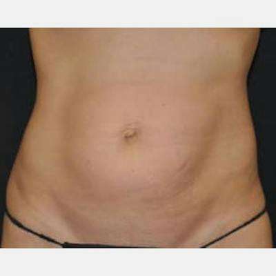 Abdominoplasty (Tummy Tuck) Before & After Gallery - Patient 114221 - Image 1