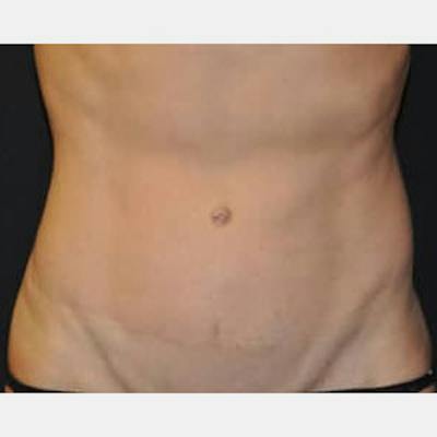 Abdominoplasty (Tummy Tuck) Before & After Gallery - Patient 114221 - Image 2