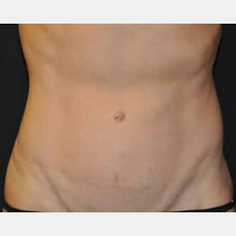 Abdominoplasty (Tummy Tuck) Before & After Gallery - Patient 114221 - Image 2
