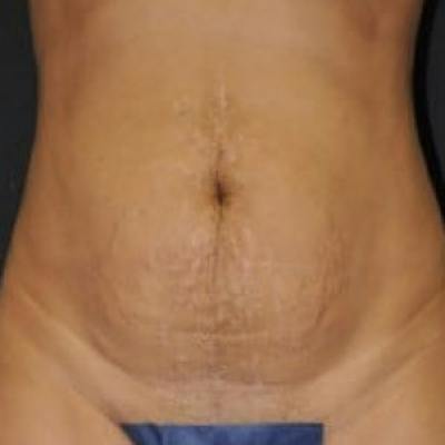 Abdominoplasty (Tummy Tuck) Before & After Gallery - Patient 376369 - Image 1