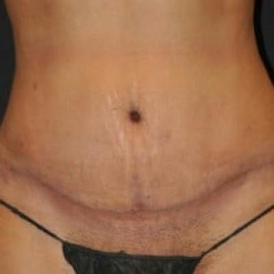 Abdominoplasty (Tummy Tuck) Before & After Gallery - Patient 376369 - Image 2