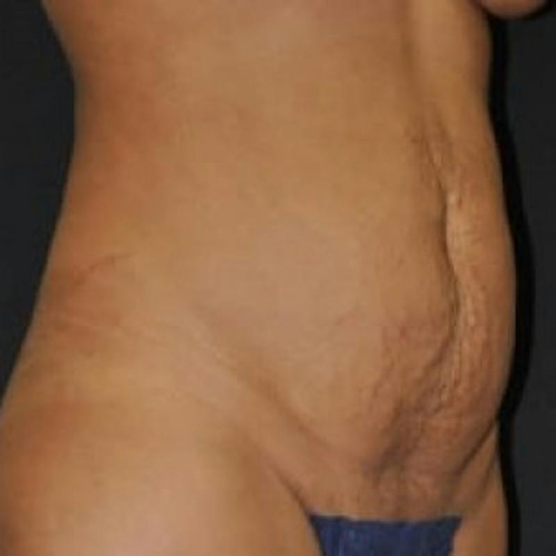 Abdominoplasty (Tummy Tuck) Before & After Gallery - Patient 376369 - Image 3