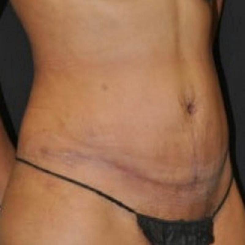 Abdominoplasty (Tummy Tuck) Before & After Gallery - Patient 376369 - Image 4
