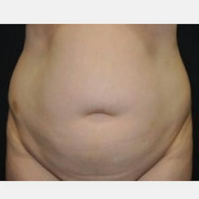 Abdominoplasty (Tummy Tuck) Before & After Gallery - Patient 256933 - Image 1