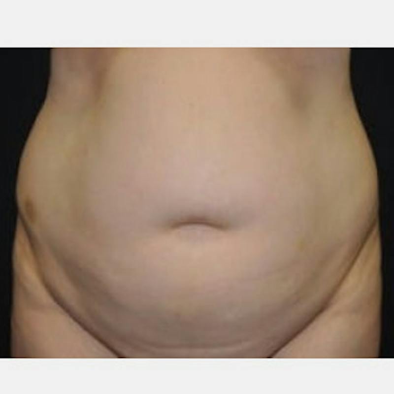 Abdominoplasty (Tummy Tuck) Before & After Gallery - Patient 256933 - Image 1