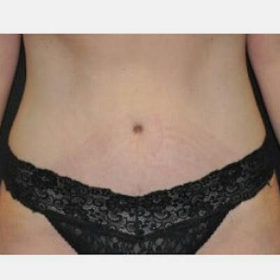 Abdominoplasty (Tummy Tuck) Before & After Gallery - Patient 256933 - Image 2