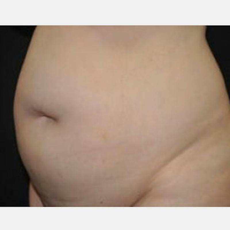 Abdominoplasty (Tummy Tuck) Before & After Gallery - Patient 256933 - Image 3
