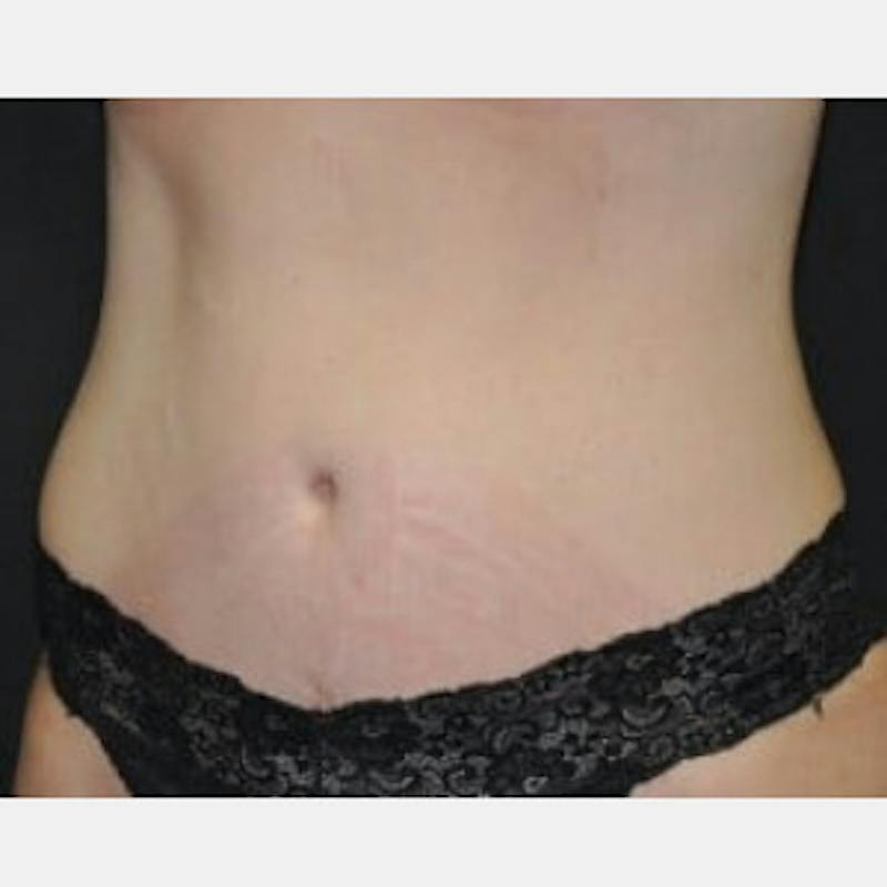 Abdominoplasty (Tummy Tuck) Before & After Gallery - Patient 256933 - Image 4