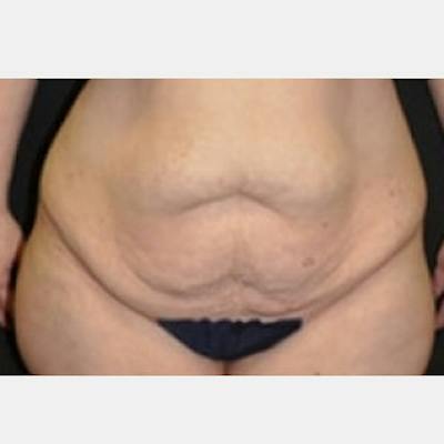 Abdominoplasty (Tummy Tuck) Before & After Gallery - Patient 388358 - Image 1