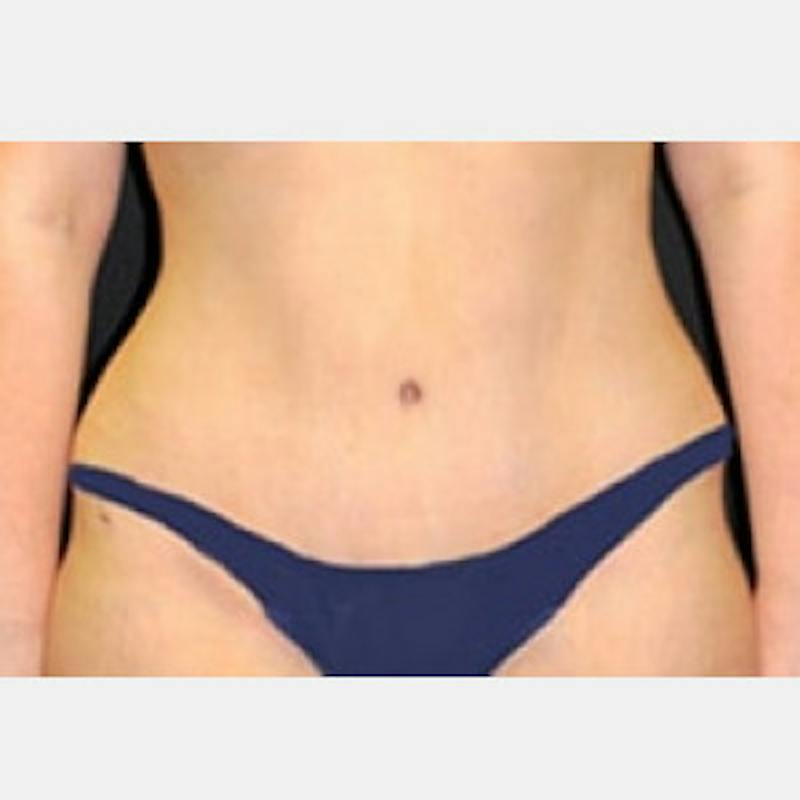 Abdominoplasty (Tummy Tuck) Before & After Gallery - Patient 388358 - Image 2