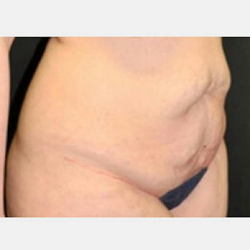 Abdominoplasty (Tummy Tuck) Before & After Gallery - Patient 388358 - Image 3
