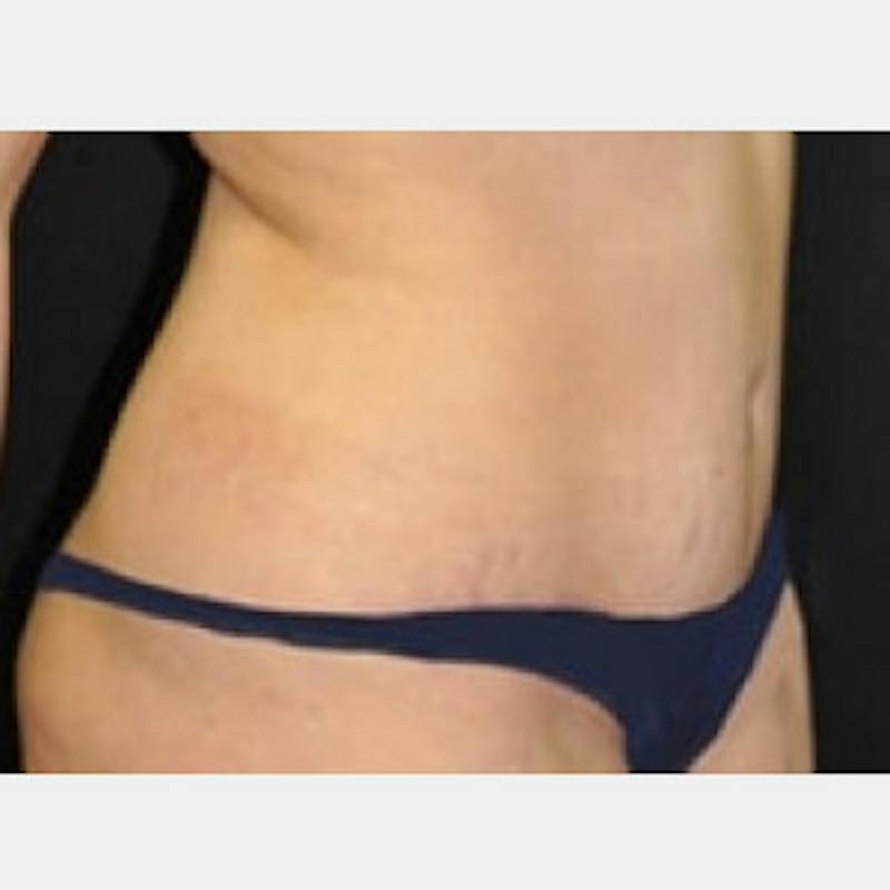 Abdominoplasty (Tummy Tuck) Before & After Gallery - Patient 388358 - Image 4