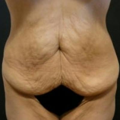 Abdominoplasty (Tummy Tuck) Before & After Gallery - Patient 275913 - Image 1